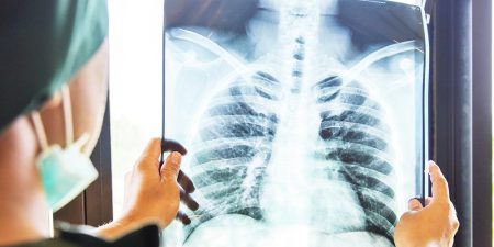 COVID-19: Αξιολόγηση και αντιμετώπιση των ασθενών με εμμένοντα συμπτώματα μετά από οξεία λοίμωξη από τον ιό SARS-CoV-2