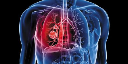 Ποιοι παράγοντες αυξάνουν τον κίνδυνο για βαριά νόσηση σε ασθενείς με καρκίνους του θώρακα και COVID-19