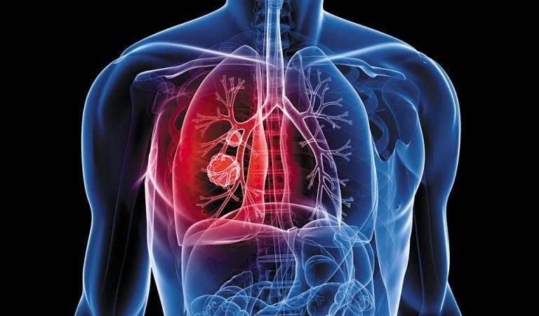 Ποιοι παράγοντες αυξάνουν τον κίνδυνο για βαριά νόσηση σε ασθενείς με καρκίνους του θώρακα και COVID-19