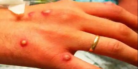 Ευλογιά των πιθήκων