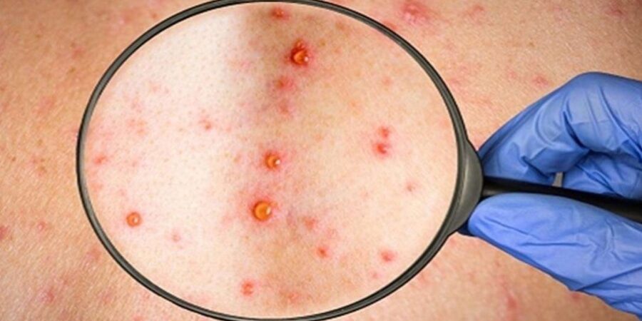 Ευλογιά των πιθήκων: Τι γνωρίζουμε σήμερα;