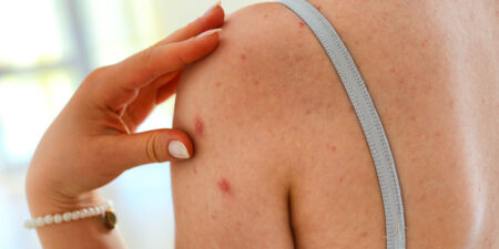 Ευλογιά των πιθήκων: Δεδομένα από το Λονδίνο