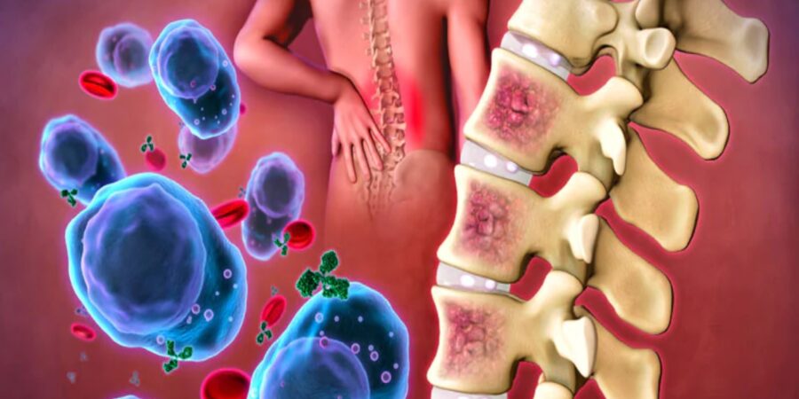 Νέα σημαντική μελέτη για την αντιμετώπιση των ασθενών με πολλαπλούν μυέλωμα με τη συμμετοχή της Θεραπευτικής Κλινικής της Ιατρικής Σχολής του ΕΚΠΑ