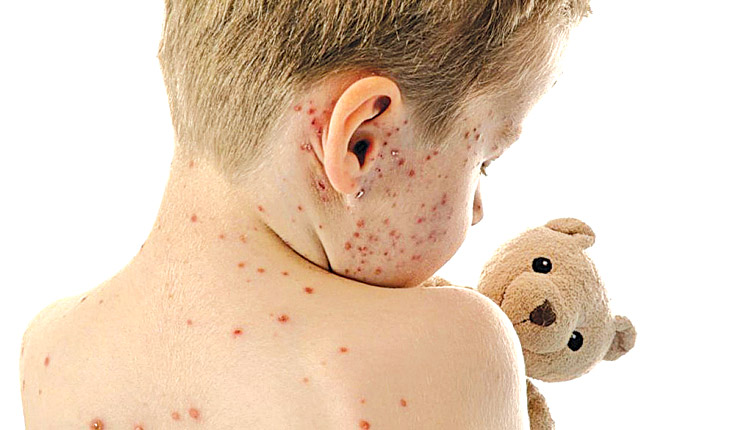 ΠΟΥ: Ανησυχητική 30πλάσια αύξηση της ιλαράς στην Ευρώπη