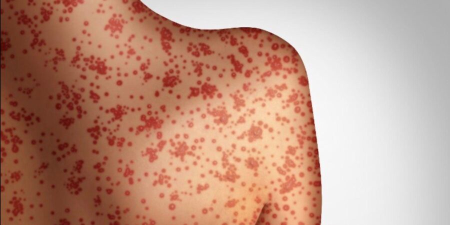 ΠΟΥ: Αύξηση κατά 79% των κρουσμάτων ιλαράς καταγράφηκε πέρυσι στον κόσμο