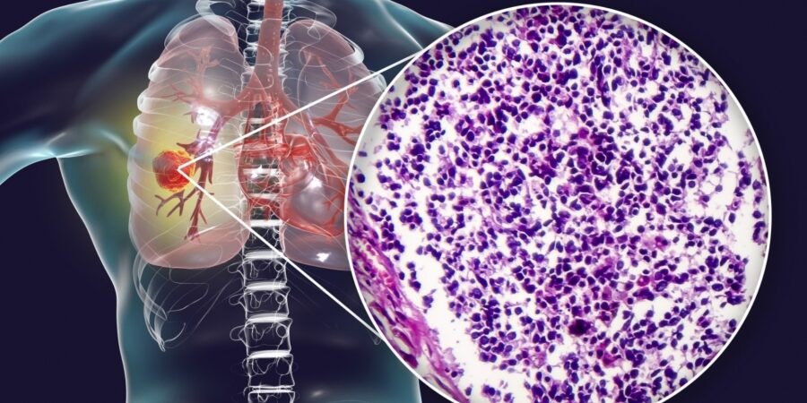 Σημαντικές εξελίξεις στην αντιμετώπιση του καρκίνου του πνεύμονα